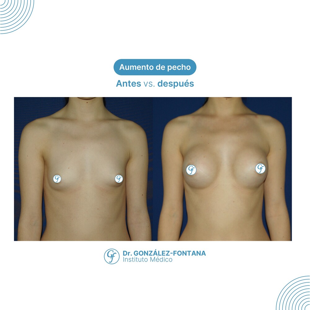 Before and After Result